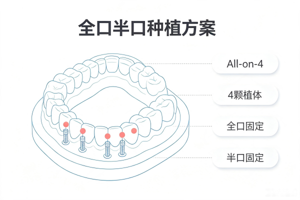 种植牙全口/半口种植方案示意图